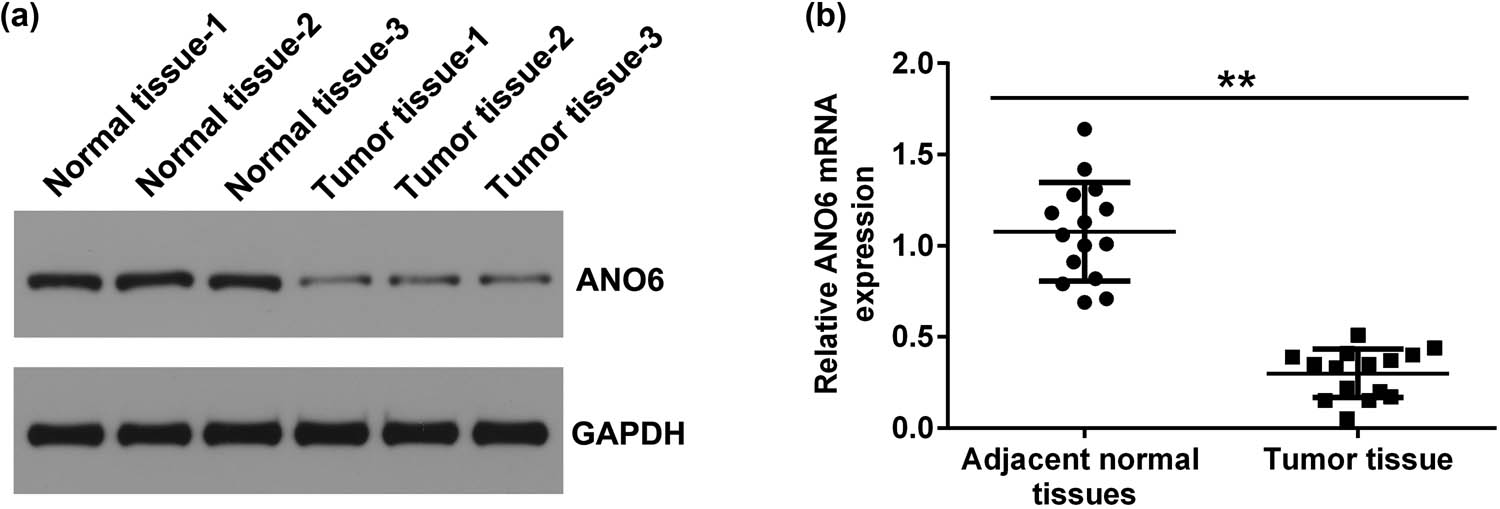 Figure 1
Expression of ANO6 (TMEM16F) in stromal tumor tissues and adjacent normal tissues of patients with GIST. Relative levels of ANO6 (TMEM16F) in stromal tumor tissues and adjacent normal tissues from patients with GISTs were evaluated by (a) western blot assay and (b) RT-qPCR. **P < 0.01.