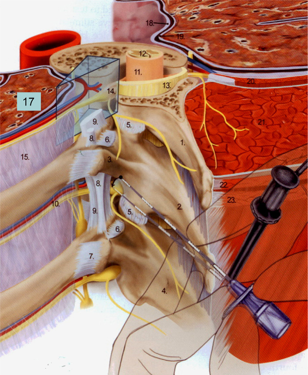 Fig. 1 
            Reproduced from Boezaart (2009, Fig. 18-4) with permission. The wedge-shaped paravertebral space is clearly indicated: comprises vessels to spinal cord, spinal nerve root and intercostal nerve, chain of sympathetic ganglia and its rami communicantes, and paravertebral part of the epidural space. 1. Transverse process of T3; 2. transverse process of T4; 5. Facet-joint; 6. costotransverse ligament; 7. lateral costotransverse ligament; 8. intertransverse ligament; 9. superior costotransverse ligament; 10. intercostal vessels and nerve; 11. dura mater; 12. Spinal cord; 13. ligamentum flavum; 14. nerve root; 15. internal intercostal membrane; 17. left lung; 18. parietal pleura; 19. visceral pleura; 21. erector spina muscle; 23. trapezius muscle.