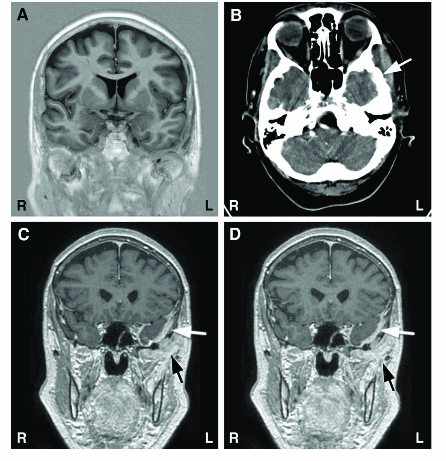 Fig. 1
Results of structural brain imaging during the course of the disease. (A) Normal native MRI of the brain taken 4 months after onset of facial pain symptoms. (B) CT image taken 10 months after symptom onset with brain window setting; incipient lytic process of low temporal bone on left side marked with an arrow (hardly visible at this magnification). (C and D) Eleven months after symptom onset, gadolinium enhanced T1-weighted MR images show clearly visible pathologic enhancement of dura (white arrows) and enhancing soft tissue metastatic mass below temporal bone (black arrows).