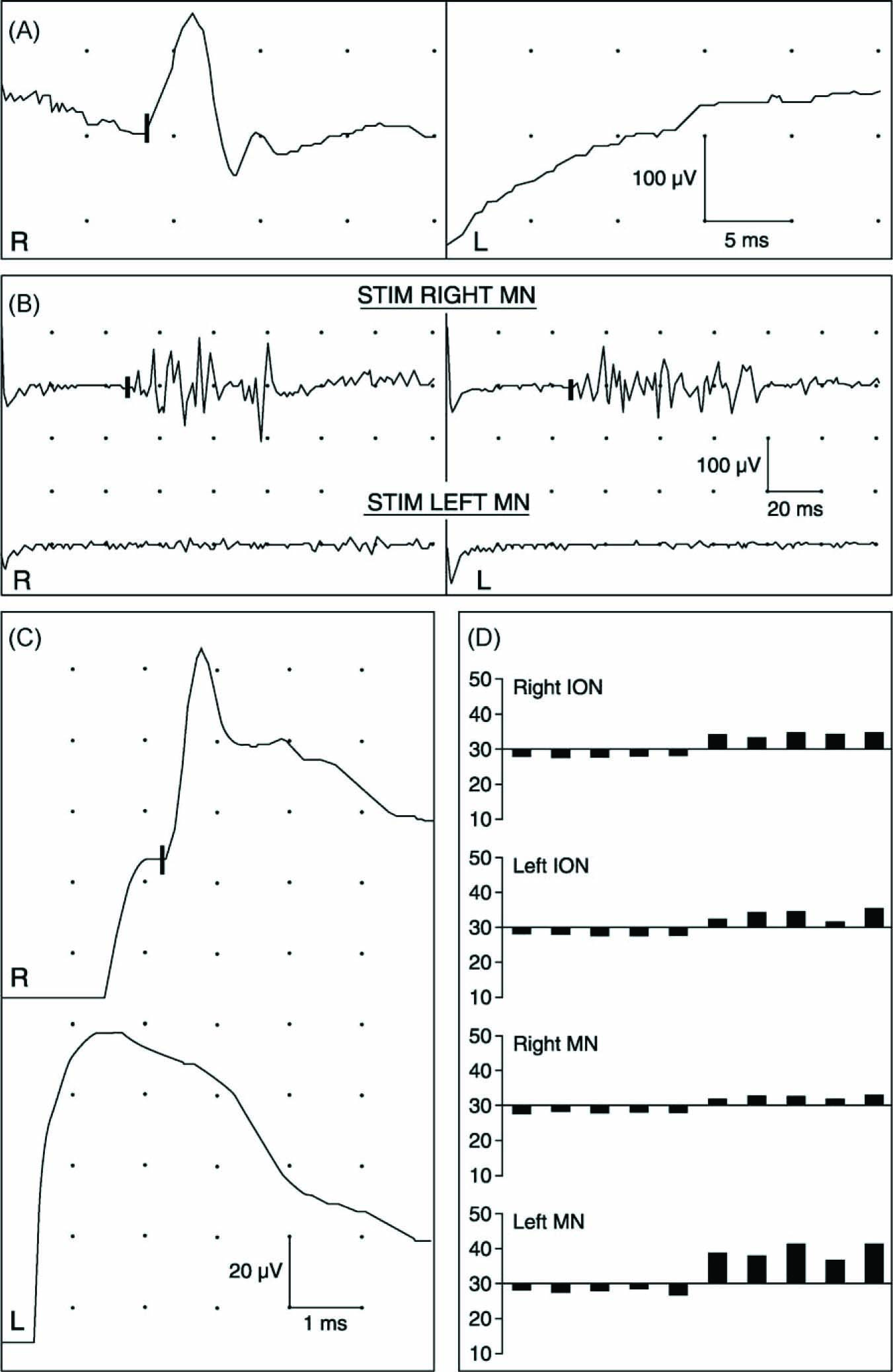 Fig. 2
Results of neurophysiologic examination 9 months after the onset of facial pain. (A) Masseter reflex recording with normal response on right (R) side, and absent response on left (L). (B) Blink reflex recording showing normal responses bilaterally with stimulation of right mental nerve (MN) and absent responses with stimulation of left MN. (C) Neurography of inferior alveolar nerve with normal sensory action potential on right side (onset of negative peak is marked on upper trace) and absent response on left side. (D) Cold (first five bars below 30 °C) and warm (next five bars above 30 °C) detection threshold measurements with stimulation at infraorbital (ION) and MN distributions on both sides. Five repetitions of each test are shown. Only warm detection threshold within left MN distribution is elevated, indicating hypoesthesia to warming.