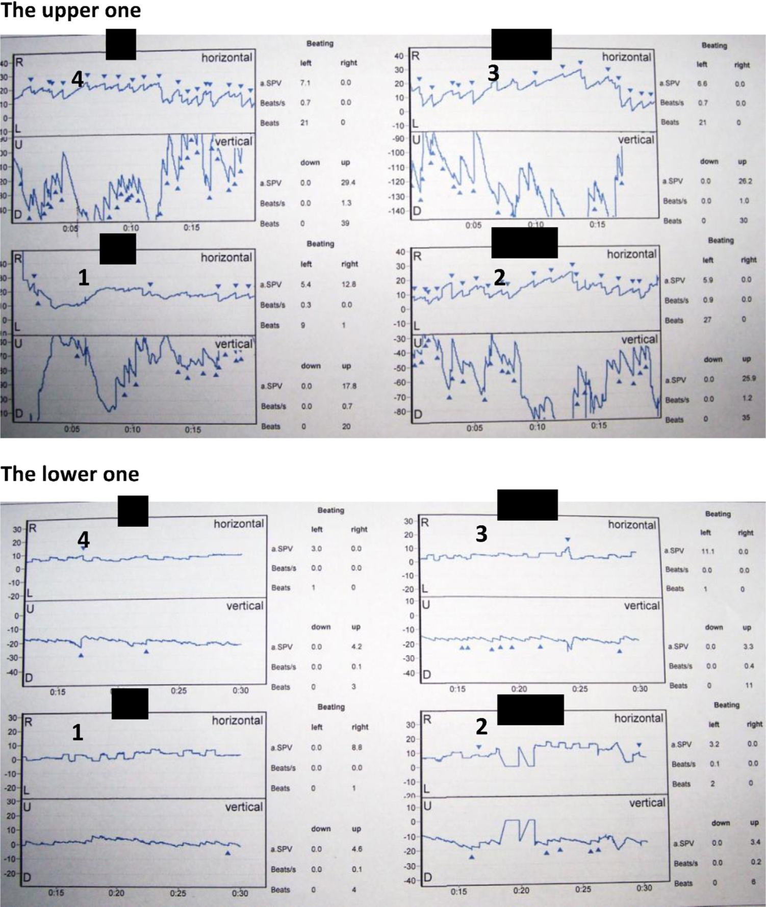 Fig. 1 
              Video-oculographic documentations of BPPV pre-treatment (the upper one) and post-treatment (the lowerone). Equipment from Interacoustics A/S, Assens, Denmark was used. The patient was tested in the Dix-Hallpike position to the right for 2 min. Each of the four rectangles (1–4) shows the first 20s of a 30s period of time. At the right side of each period illustration (1–4) the quantitative details are given, i.e., the counts of nystagmus and their orientation (right, left, up and down) during a 30 s period, beats per second, and SPV, i.e. Slow Phase Velocity of nystagmus beats. The recordings are from a 38 year old man with an eight years history of chronic widespread pain and fatigue after a traffic road accident. His level of pain varied from 5 to 9 on a visual analog scale of pain (0–10). Pain was the absolutely devastating symptom. There was no report of vertigo but dizziness. DHI-score was 60. The test results are shown in the upper illustration. The patient underwent treatment of BPPV in the anterior, posterior and horizontal SSCs bilaterally. During a period of one year he improved significantly. During this year he had some relapses, which were treated. In total he received 15 treatments. The only recommendation given as a home-exercise program was walking (hiking) with gradual increase in distance and intensity. Exactly one year after the first examination he was reexamined (the lower one) in the Dix-Hallpike position to the right for 2 min. The illustration shows very few nystagmus beats compared with the pre-treatment figure. After this late control the patient has been working full time as a handyman without any complaints.
            