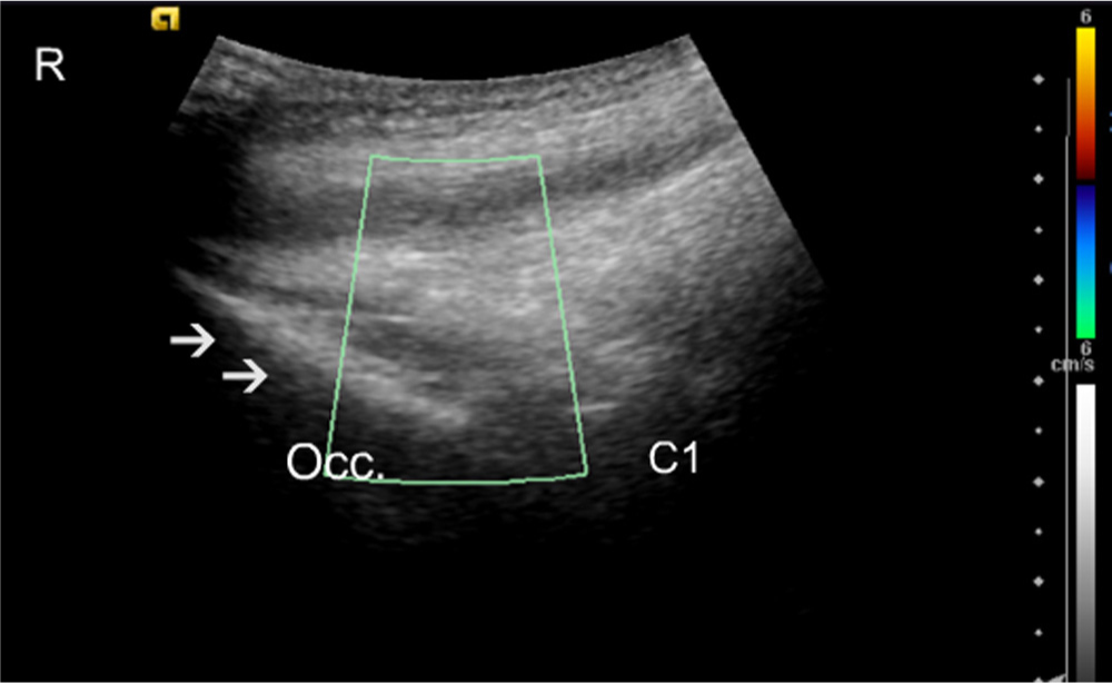 Fig. 1 
              Control subject longitudinal midline. Colour Doppler scan. The C1 area is shown with no apparent blood vessels. Arrows identify the occipital bone (Occ.). R, rostral.
            