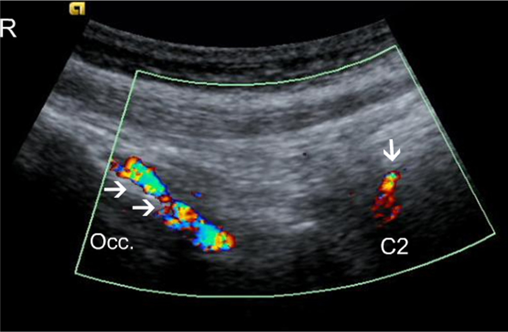Fig. 2 
              Longitudinal colour, Doppler scan of a patient. Arrows identify blood vessels jusxtapositioned to the occipital bone (Occ.); the single arrow indicates the C2 spinous process and blood flow in the vessels juxtapositioned to it. Occ., Occipital bone; R, rostral.
            