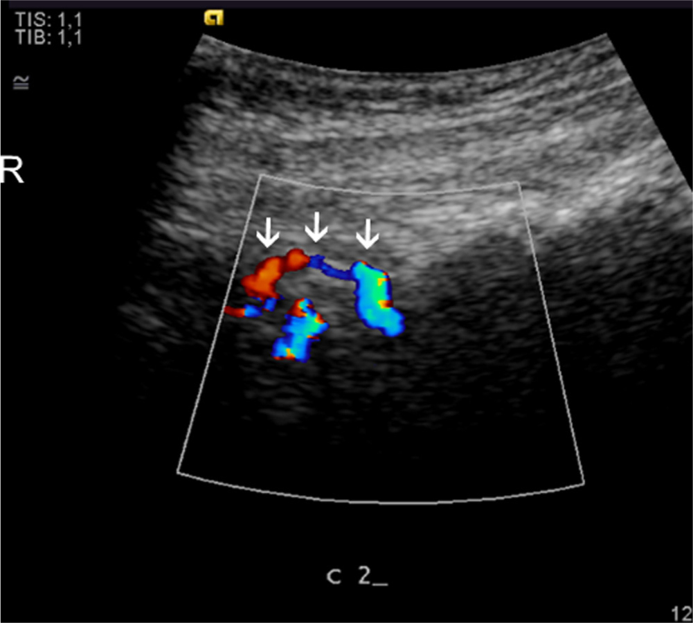 Fig. 3 
              Longitudinal colour, Dopplerscan of a patient. Arrows identify the C2 spinous processes with blood vessels in the tendons. R, rostral.
            