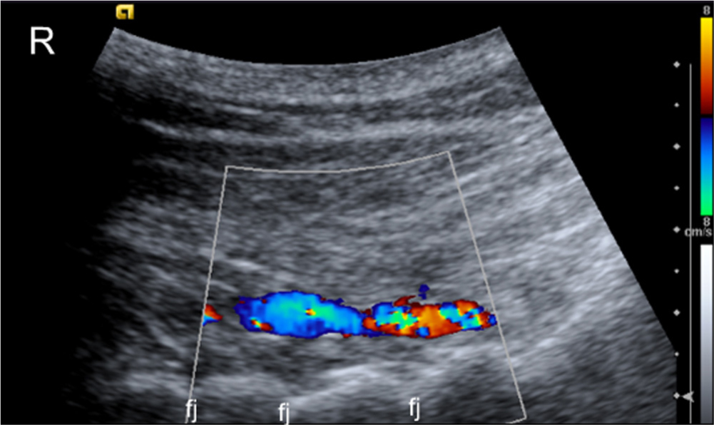 Fig. 4 
              Longitudinal colour, Doppler scan of a patient with blood vessels in muscles juxtapositioned to the midcervical facet joints. Fj, facet joints; R, rostral.
            