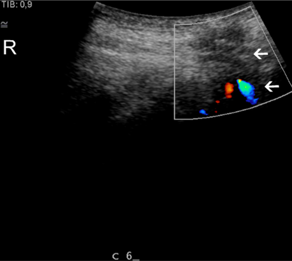 Fig. 6 
              Longitudinal colour, Doppler scan of a patient. C6 spinous processes. Arrows identify homogeneity and blood vessels in the intraspinous ligament. R, rostral.
            