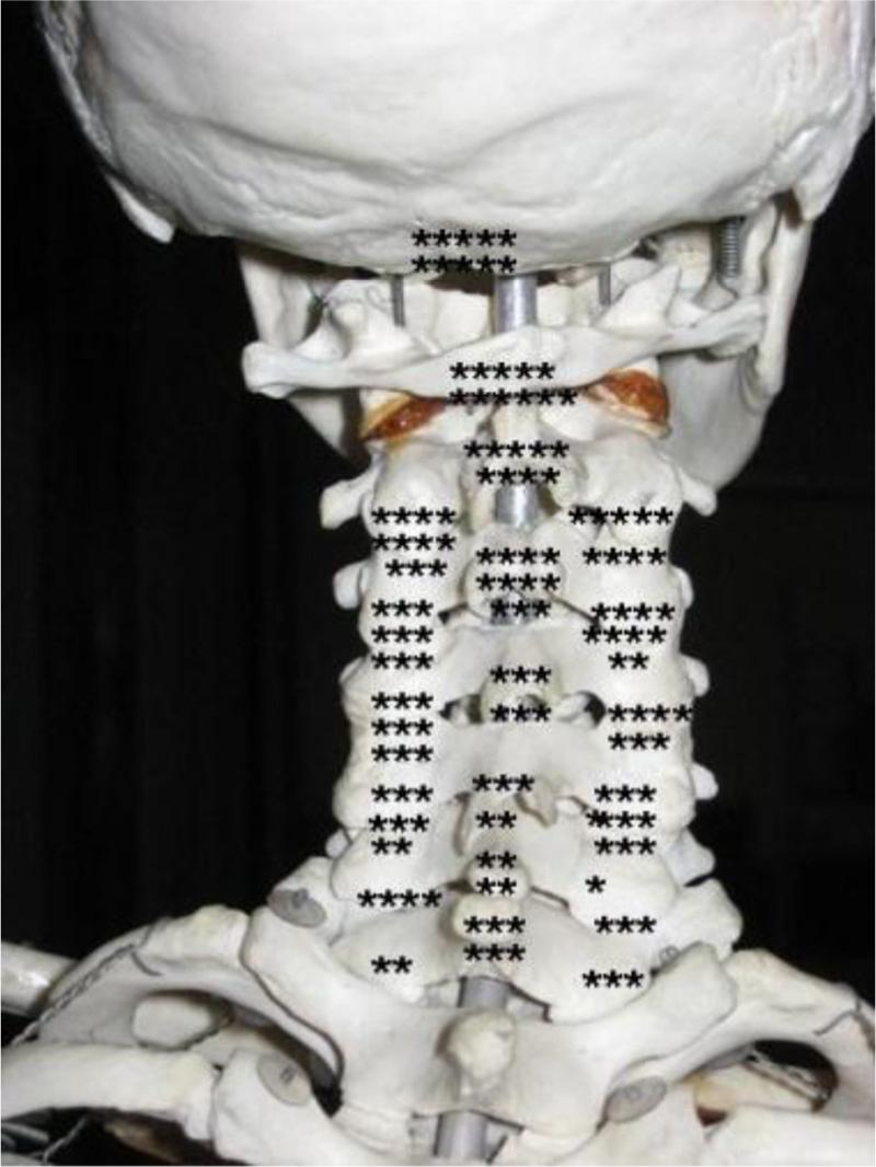 Fig. 7 
              Distribution of high blood flow in 20 patients. Each dot represents the localization of high blood flow found in a region in a single patient (regardless of intensity).
            