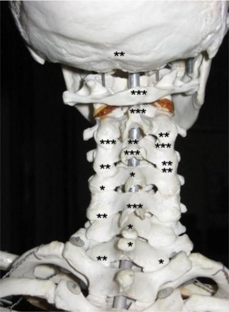 Fig. 8 
              Distribution of high blood flow in 20 controls. Each dot represents the localization of high blood flow found in a region in a single control (regardless of intensity).
            