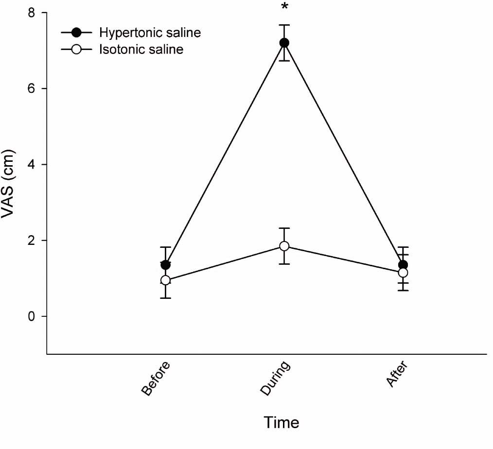 Fig. 2
Pain intensity of saline-induced pain demonstrated as mean NRS scores (±SEM; N = 10, during pain after hypertonic saline N = 9). VAS scores are presented as baseline (before), during and after injection of hypertonic (filled circles) and isotonic saline (open circles). *NRS was significantly increased after hypertonic saline compared with isotonic saline (P × 0.0001).