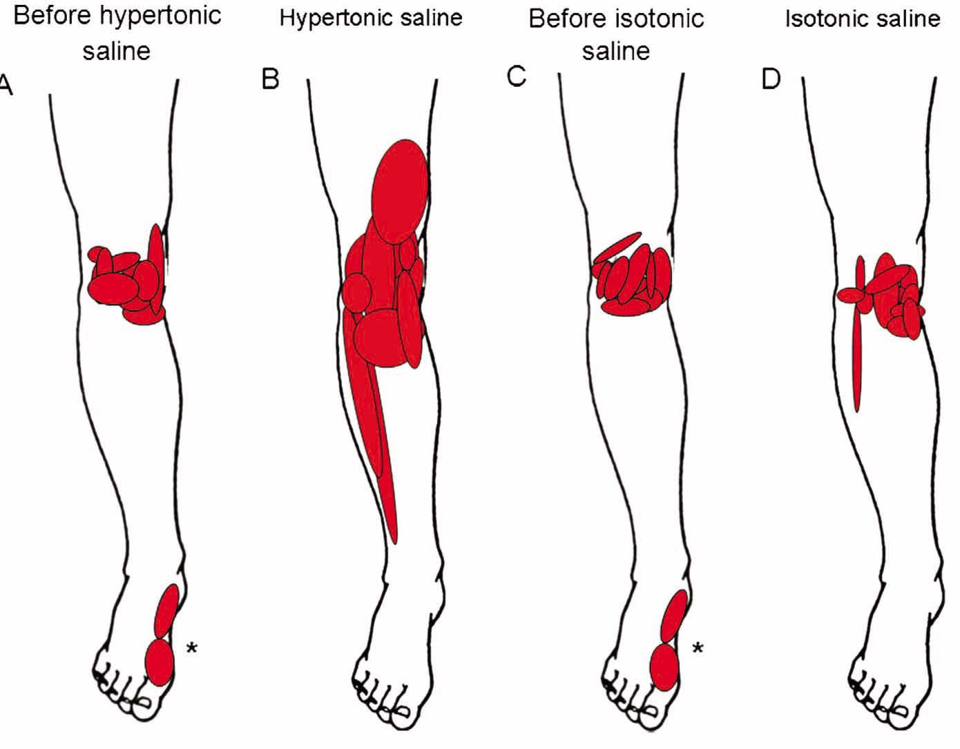 Fig. 3
The individual pain distribution superimposed on anatomical drawings at baseline (A, N = 10), before hypertonic saline (B, N = 10), after experimental pain induced by hypertonic saline (C, N = 9), before the control condition with injection of isotonic saline (D, N = 10), and after injection of isotonic saline (E, N = 10). *The referred pain areas in the foot are from one individual.