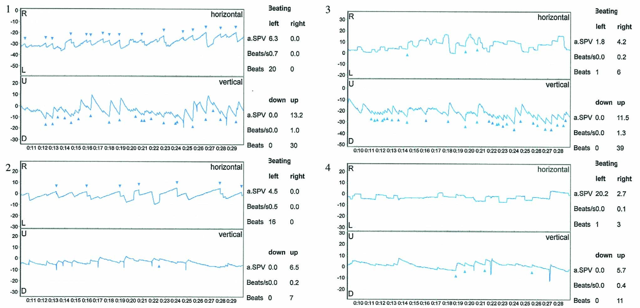 Fig. 1
Video-oculographic documentations of BPPV. (1) Demonstrates an affection of the posterior SCC in the left labyrinth. The patient is lying on his left side; his head turned 45° up. The rectangle shows the last 20s of a 30s sequence. At the right side of each rectangle the quantitative details are given, i.e., the counts of nystagmus and their orientation (left, right, down and up) during a 30s period, beats per second, and SPV, i.e., Slow Phase Velocity of nystagmus beats. This patient had 20 left-directed horizontal nystagmus beats and 30 up-right vertical nystagmus beats. (2) Demonstrates the nystagmus appearance after coming back into an upright position. Now the horizontal nystagmus beats are dominant and this is interpreted as a possible horizontal SCC affection. (3) Demonstrates an affection of the anterior SCC in the left labyrinth. The patient is lying on his right side; his head turned 45° up. The patient had 39 up-right directed vertical nystagmus beats and six right horizontal directed nystagmus beats. (4) Demonstrates the nystagmus appearance after returning into an upright position. There are now very few nystagmus beats. The video-oculographic picture was interpreted as a multicanalicular canalithiasis with an affection of the anterior and posterior SCCs as well as a possible affection of the horizontal SCC in the left labyrinth. The recordings are from a 52 year old man with a 2 year history of neck pain and fatigue after a road traffic accident. The patient received repositioning of otoliths in all three SCCs, left side, and he improved significantly.