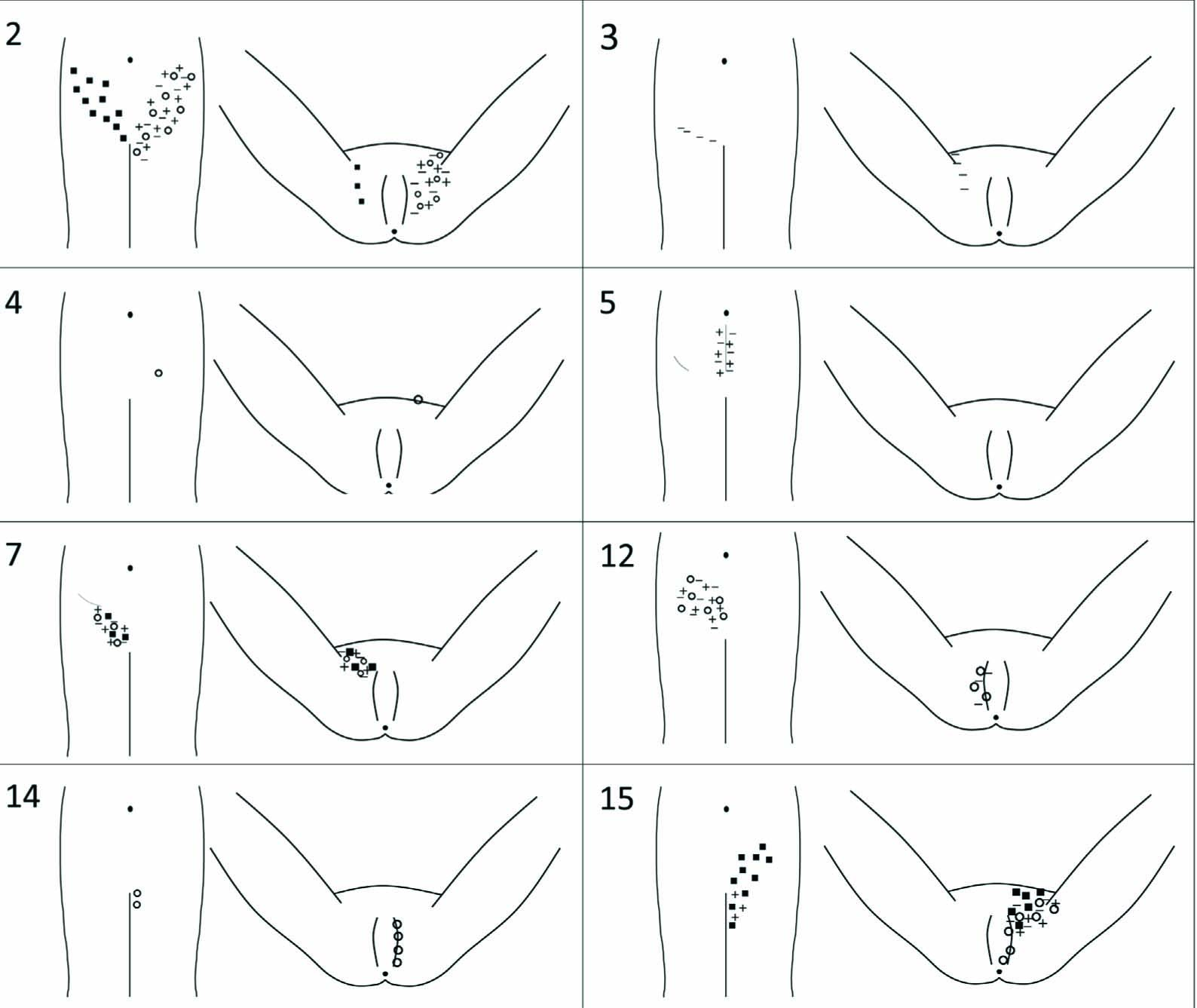 Fig. 2 
              Drawings showing the sensory changes in eight patients. + corresponds forwarm, – for cold, both examined with the thermal roller. Black square □ stands fortouch (cotton stick) and open circle ⵔ for pin prick (wooden stick). The numbers in the left corner correspond to the patient id of this study.
            
