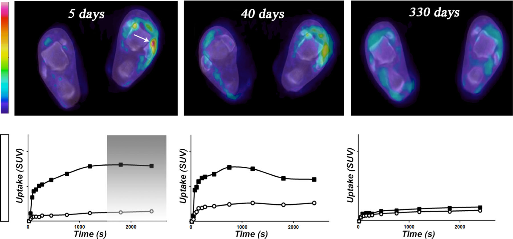 Fig. 2 
              Patient case illustrating decreased [11C]DDE uptake between acute injury and follow-up.
              A 20-year-old female (case 3) with a classic lateral inversion ankle sprain. The top row displays fused transaxial [11C]DDE PET/CT images of the feet. The color bar indicates SUV values from 0 (dark blue) to 2.5 (red). Location of left anterior fibulotalar ligament (FTA) is indicated by a white arrow. The bottom row displays respective time activity (TACT) curves (black rectangles represent injured FTA and white circles control region). The bar indicates SUVMEAN values from 0 (bottom) to 2.5 (top). The gray rectangle indicates the data (25–45 min post tracer administration) that was used for the generation of dependent variables (SUVMEAN, SUVMAX and SUVRATIO). The region of FTA initially showed visually significant [11C]DDE uptake that was undetectable 11 months after the injury indicating recovery of the tissue damage. (For interpretation of the references to color in this figure legend, the reader is referred to the web version of the article.)
            