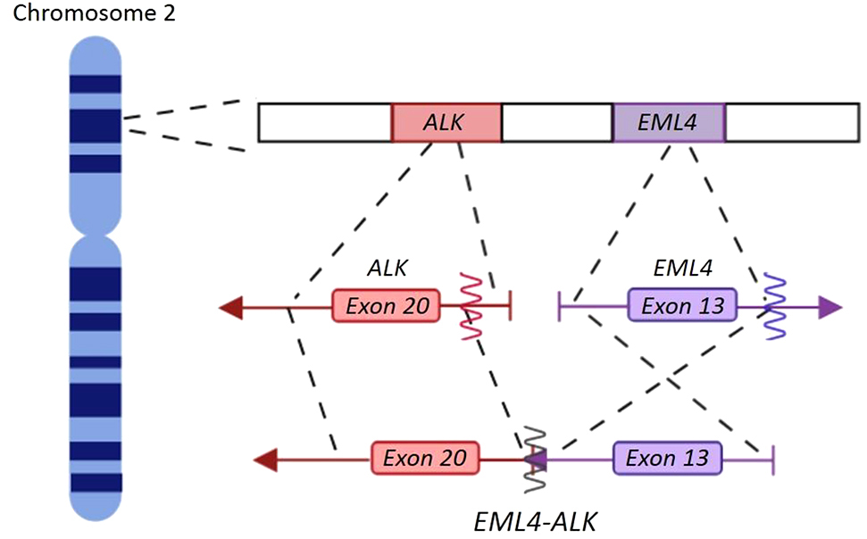 Figure 1: 

EML4-ALK translocation.

ALK (red) and EML4 (purple) genes are located in the short arm of chromosome 2 and they are oriented in opposite directions. Arrows indicate the orientation of the genes. The translocation occurs through a paracentric inversion [inv(2)(p21p23)] leading a fusion transcript that contains ALK catalytic domain and EML4 amino-terminal half. (Figure designed by https://app.biorender.com/).
