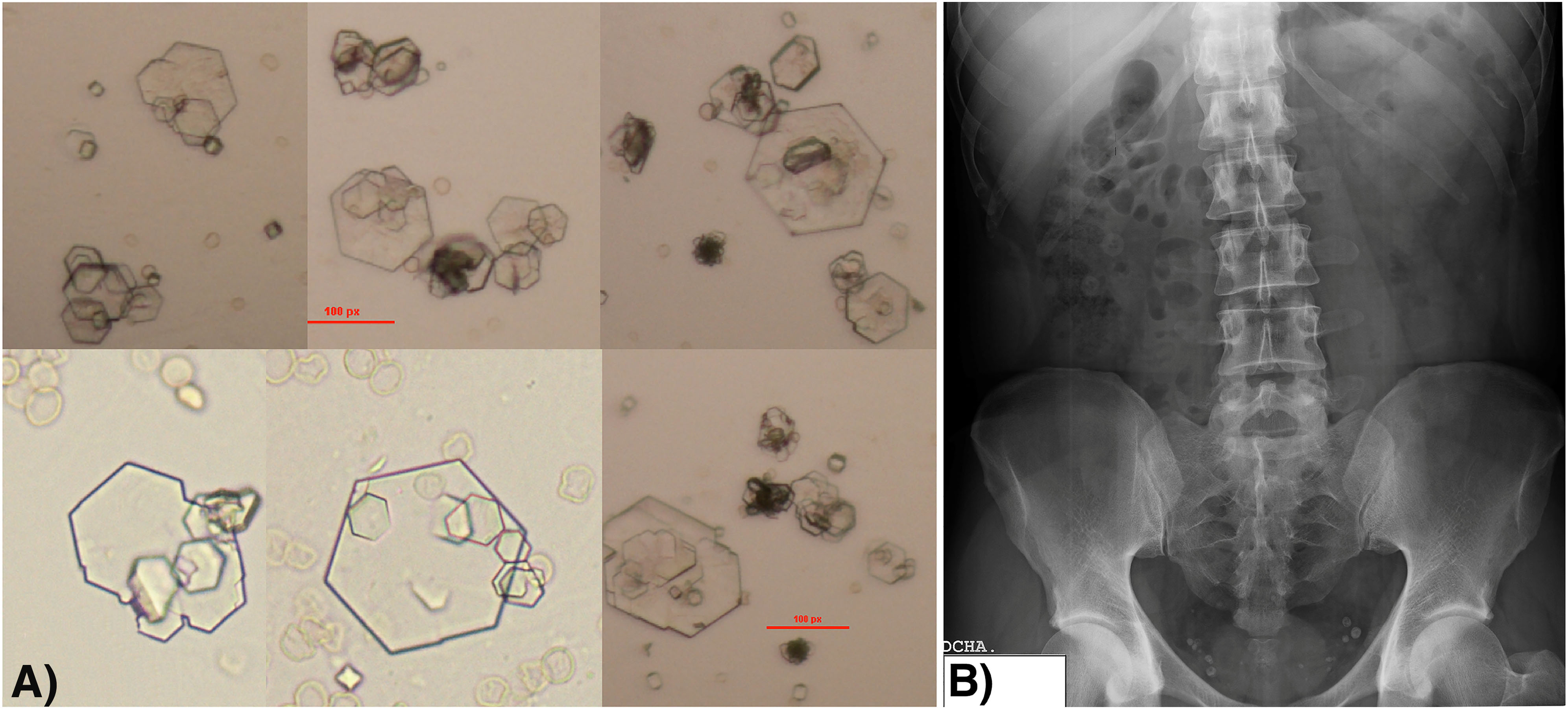 Figura 1: 
Imágenes de algunas de las pruebas complementarias que se realizaron al paciente.
(A) Sedimento urinario al ingreso del paciente referido (400×). Se observan cristales hexagonales y planos de pequeño tamaño (10–20 µm) con diferentes niveles de maclación. En las distintas imágenes aparecen maclas de mediano tamaño y/o de gran tamaño compuestas en estratos o escalera característica de este tipo de cristales. (B) Radiografía simple de abdomen mostrando varios flebolitos no relacionados con la litiasis.
