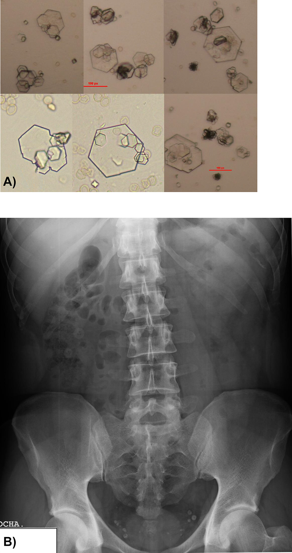 Figure 1: 
(A) Urine sediment on admission (400×).
Small, flat, hexagonal-shaped crystals (10–20 µm) with different levels of twinning. Presence of medium-sized and large twinnings arranged in the layers or ladder typical of this type of crystals. (B) Simple abdominal X-ray showing the presence of several phleboliths unrelated to lithiasis.
