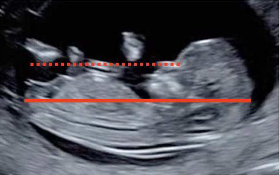 Figure 1: 
CRL measurement standards.
Examination can be transvaginal or transabdominal. CRL between 45 and 84 mm. Midsagittal plane: Sagittal section of the fetus with the head in line with the body. The view must include the echogenic tip of the nose, the nasal bone if present, the diencephalon (do not include the orbit), the insertion of the umbilical cord, the bladder and the genital tubercle. The lower limbs should not be visible. Correct visualization of the cephalic and caudal pole with identification of the crown, the rump and the skin around them. Neutral fetal position, neither flexed (the pocket of amniotic fluid between the lower chin and the thorax must be equal to or greater than the width of the palate); nor extended (Fetal palate angle should be between 30° and 60° with respect to the long axis). Orientation: the plane of CRL should be 0–30° with respect to the horizontal so that the angle between the ultrasound beam and the CRL measurement line is 90°. To ensure that the fetal length is as close as possible to the horizontal, draw a line from the tip of the nose, which should be at the level of or above the abdominal wall with respect to the horizontal. Magnification: the CRL should occupy more than 60% of image space and the entire crown-rump must be seen. Correct caliper placement: place the calipers on the outer border of the skin on the fetal head and rump. Measure the CRL three times and report the mean of three acceptable measurements.