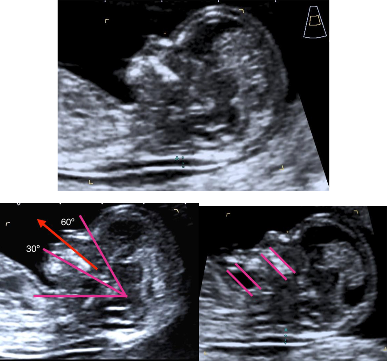 Figure 2: 
NT measurement standards.
Examination can be performed via transvaginal or transabdominal route. CRL between 45 and 84 mm. Magnification: the image should only include the head and upper thorax. Fetus in neutral position with the head in line with the spine (hyperflexion may result in a lower NT value, whereas an extended position may increase it). Criteria for ensuring a neutral head position: 1. Fetal palate angle should be between 30° and 60° with respect to the long axis. 2. The pocket of amniotic fluid between the lower chin and the thorax must be equal to or greater than the width of the palate. Midsagittal section with the presence of the echogenic tip of the nose, the rectangular shape of the palate, the diencephalon, and the nuchal membrane. The alveolar bone should not be visible. Measure the NT at the maximum echolucent space. Calipers on-on: the cross of the calipers should be placed on the inner borders of the nuchal fold. Reduce the gain to avoid incorporating the amnion Identification of the amniotic membrane separated from the fetus and possible umbilical cord interposition. If the umbilical cord is around the fetal neck, use the average of the measurements of NT above and below the cord.