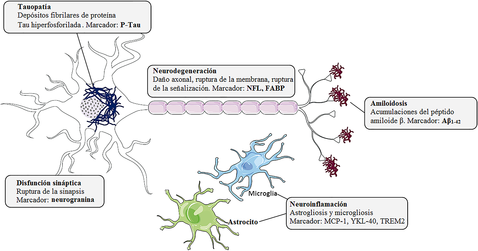 Figura 1: 
Marcadores biológicos de alteraciones histopatológicas en la enfermedad de Alzheimer. Placas seniles, compuestas por acumulaciones del péptido amiloide β (Aβ), ovillos neurofibrilares (NFT) formados por depósitos fibrilares de la proteína Tau hiperfosforilada (p-Tau), neuroinflamación, disfunción sináptica y neurodegeneración.
