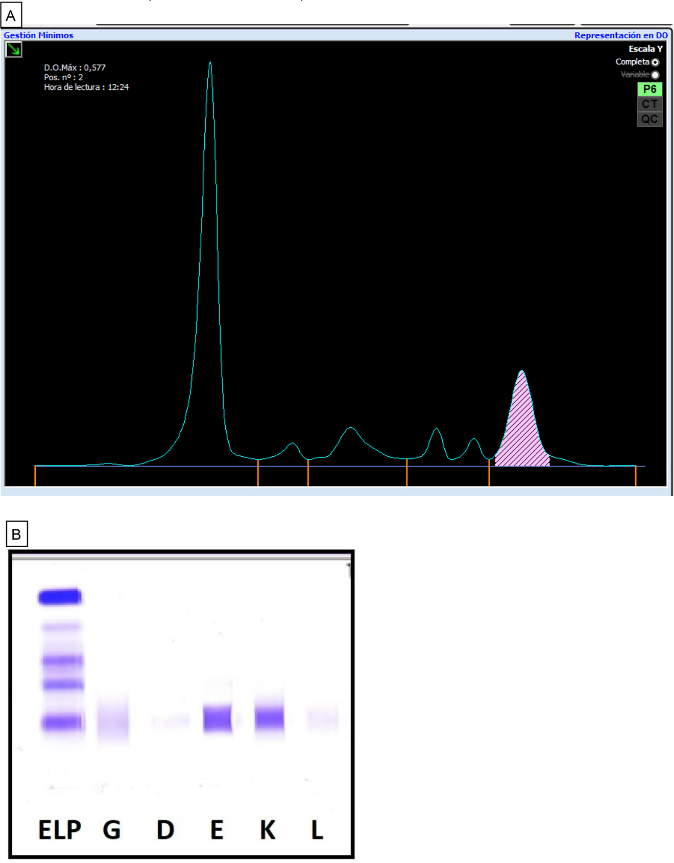 Figura 1: 
Estudio de proteínas séricas del paciente.
(A) Proteinograma en suero (Capillarys-2® Sebia), donde se señala un pico correspondiente al CM sobre la fracción γ. (B) Inmunofijación en suero (Hydragel IF, Hidrasys Sebia®), donde se identifica el CM de tipo IgE-Kappa (bandas en los carriles correspondientes a los antisueros anti-igE y anti-CLL Kappa).