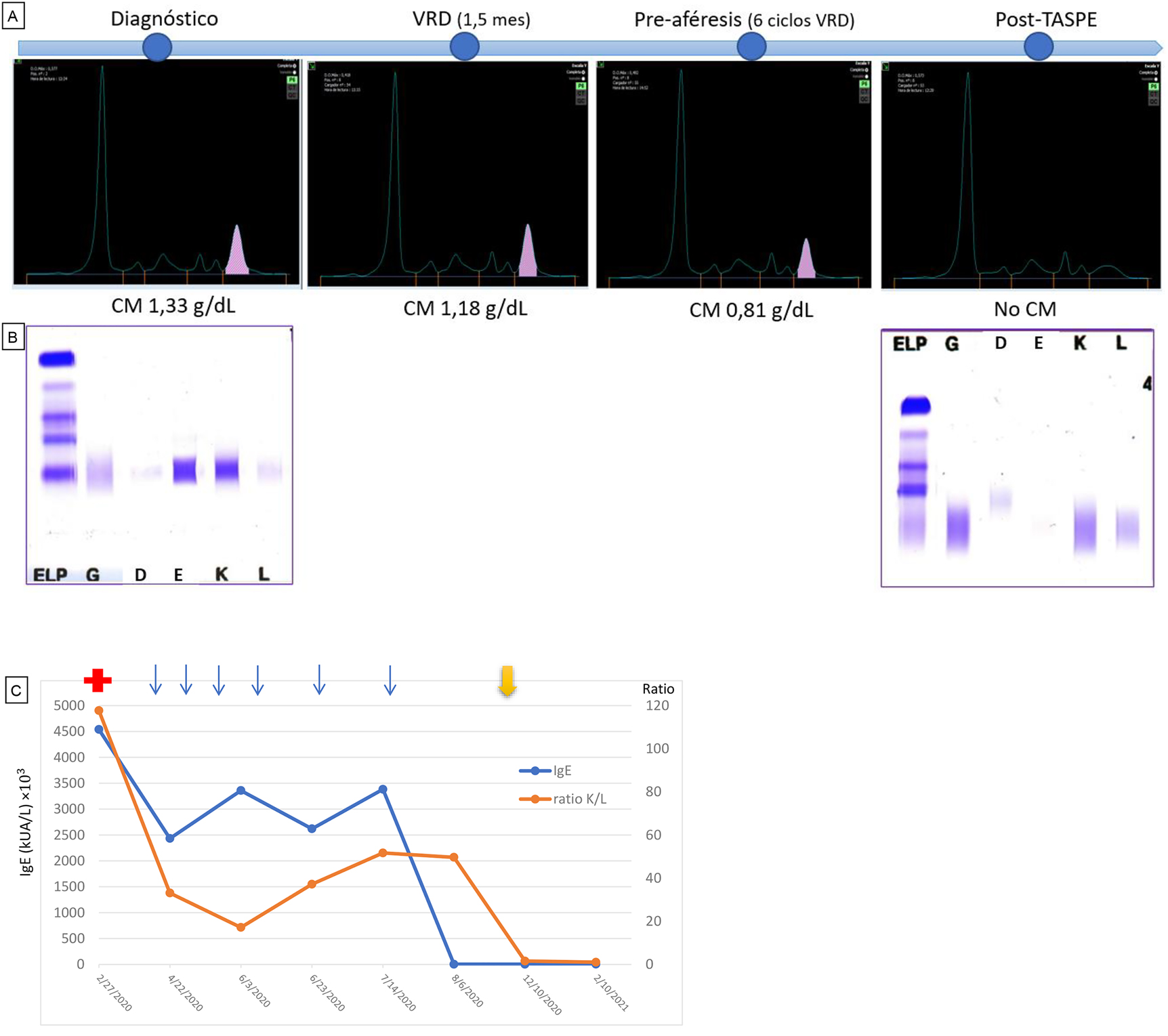 Figura 2: 
Evolución del estudio de proteínas del paciente.
(A) Evolución del proteinograma sérico: al diagnóstico, con el tratamiento VRD, pre-aféresis y post-TASPE. Se observa que el pico monoclonal sobre la fracción γ va disminuyendo. (B) Geles de inmunofijación sérica. Se observa el CM de tipo IgE-Kappa al diagnóstico y su desaparición tras el trasplante. (C) Representación de la evolución de los niveles de IgE séricos y el ratio Kappa/Lambda. La cruz roja inicial indica el diagnóstico de la patología, cada flecha azul representa un ciclo de VRD y la flecha amarilla final indica la realización del TASPE. Se observa una disminución de la concentración en suero de IgE y de CLL-Kappa.