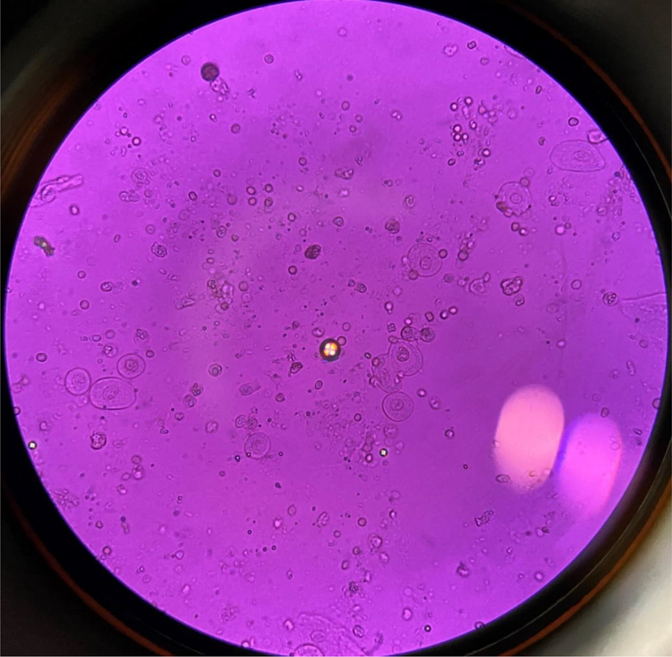 Figura 2: 
Cuerpos de cruz de Malta en orina de paciente con síndrome nefrótico, 40×.
(Fotografía realizada por los autores).
