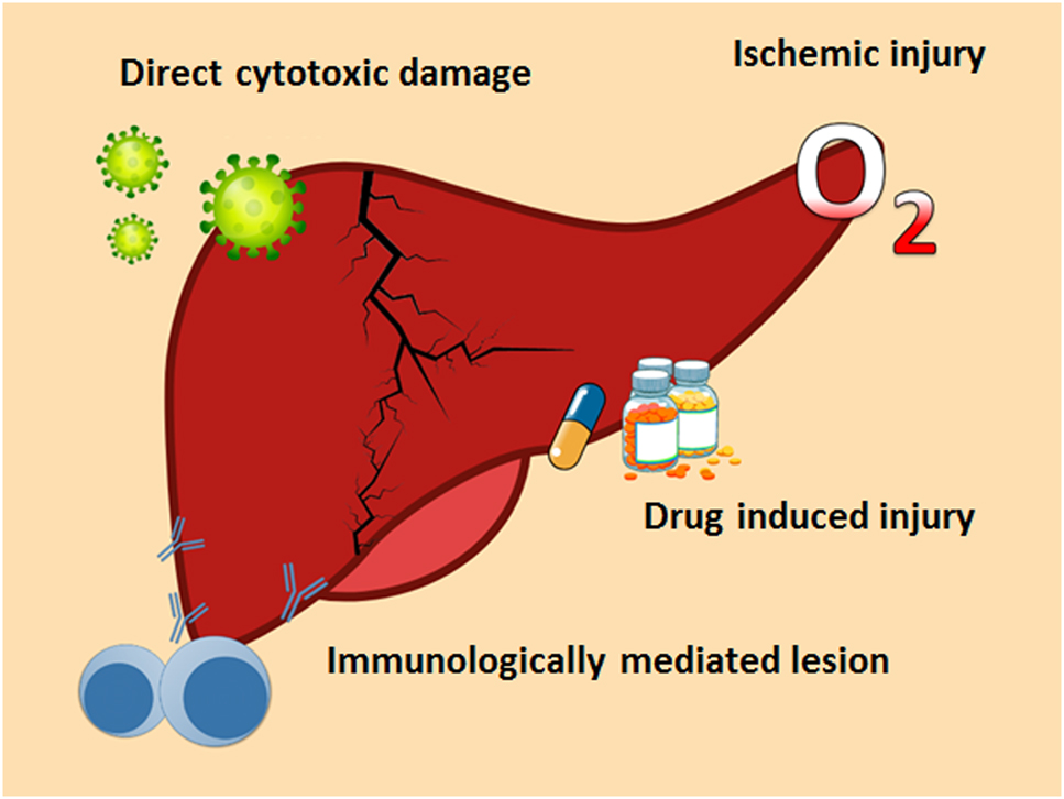 Figure 2: 
Mechanisms that induce liver damage in patients SARS-CoV-2 infection.
