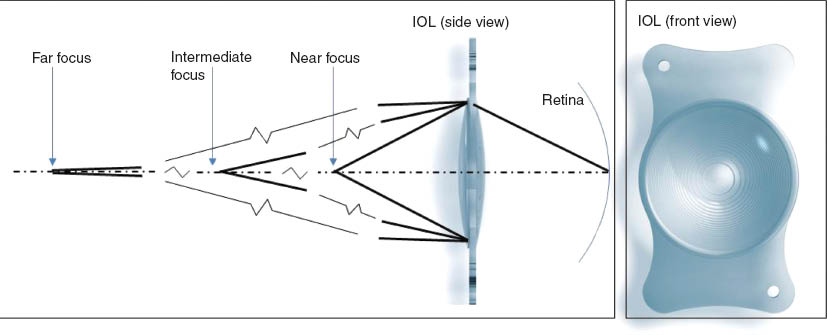 Figure 4 (Left) Schematic illustration of the basic working principle of a diffractive intra-ocular lens. Objects from three different distances to the eye are focused simultaneously on the retina, where different diffraction orders are used. (Right) Front view of an exemplary diffractive multifocal IOL with clearly visible concentric ring system (Courtesy of Carl Zeiss Meditec AG).