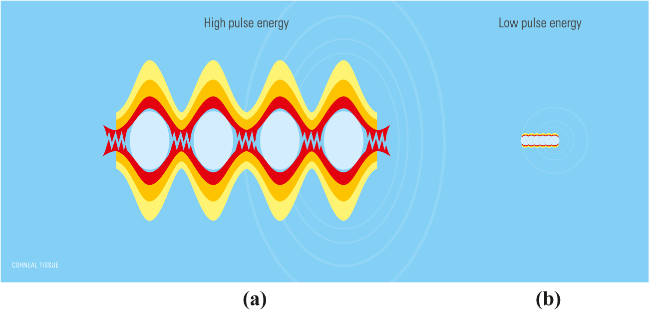 Figure 4:
a) High pulse energy, low pulse frequency (large spot separation). The color gradings symbolize the strain levels in the tissue surrounding the induced bubbles; b) low pulse energy, high pulse frequency (small spot separation, overlapping plasma interaction zones). Copyright© Ziemer Ophthalmic Systems.