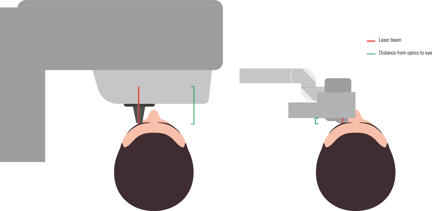 Figure 6:
Typical eye docking methods of fs lasers (a) head under laser gantry, long distance from optics to (b) articulated arm with handpiece placed onto the eye, very short distance from optics to eye; green markings indicate working distance of laser optics. Copyright© Ziemer Ophthalmic Systems.