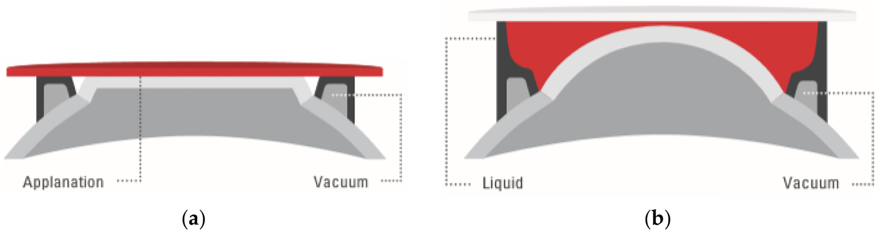 Figure 7:
Typical patient interface designs: (a) contact interface in direct touch with the cornea (flat). (b) Liquid optics interface, no direct touch on the cornea, no deformation. Copyright© Ziemer Ophthalmic Systems.