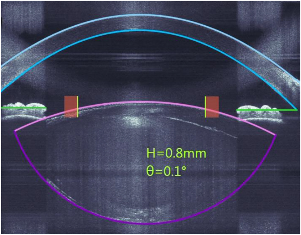 Figure 8:
Example of the OCT-guided placement of an fs laser cut pattern for cataract surgery: blue: corneal anterior and posterior surface, pink and purple: lens anterior and posterior surface, green: iris plane, yellow: capsulotomy cut, brown: safety margins to iris. Copyright© Ziemer Ophthalmic Systems.