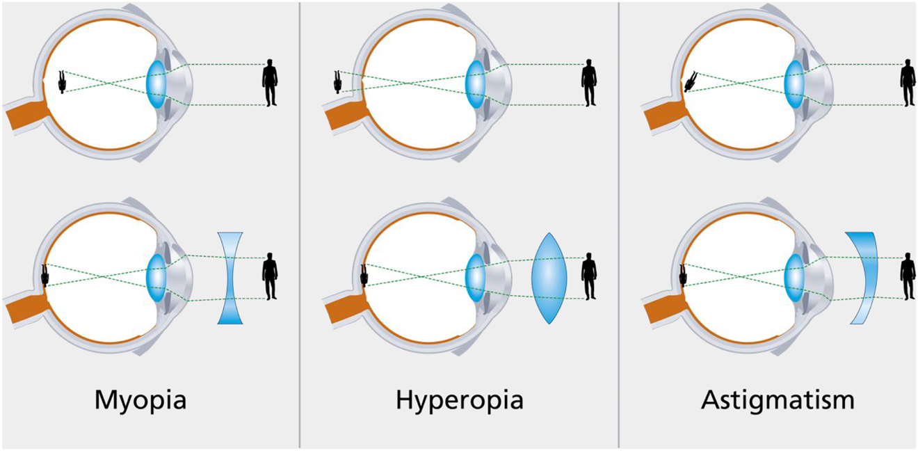 Figure 10:
Illustration of different types of refractive error and their correction with lenses. Corneal refractive surgery changes the shape of the cornea according to the corrective lenses. Copyright© Dardenne Clinic.