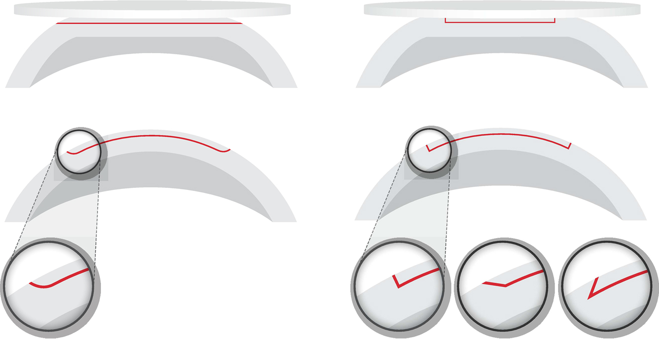 Figure 11:
Corneal flaps cut by fs-laser: (a) straight plane (red) with continuously curved sides cut during vacuum docking to a flat interface and (b) angulated side cut options (3D cutting geometry). Copyright© Ziemer Ophthalmic Systems.