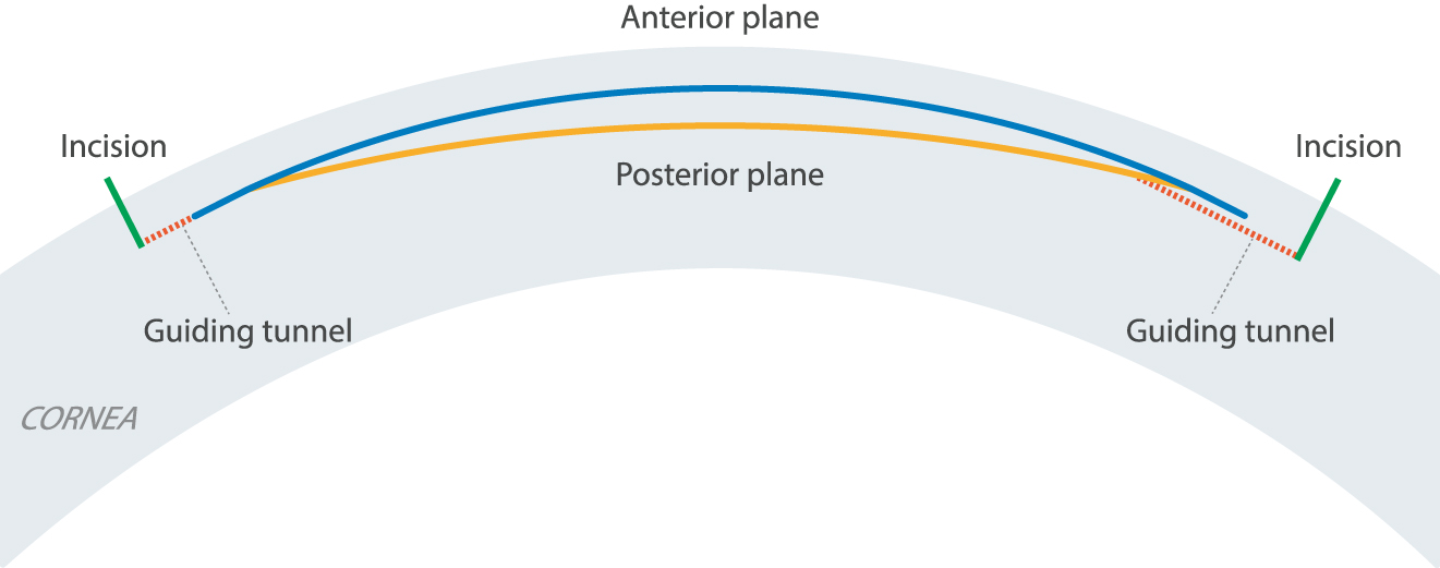 Figure 12:
Schematic view of intrastromal lenticule cuts performed by fs-laser. The lenticule created between the anterior (blue) and posterior (yellow line) cut planes is extracted by the surgeon via an incision (green line). Optionally, there is a second incision created to help mobilize the lenticule. Copyright© Ziemer Ophthalmic Systems.