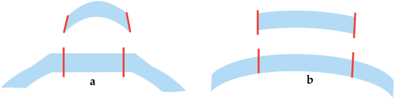 Figure 13:
Comparison of donor and recipient trephination profiles. (a) Applanation and (b) liquid optic interface. Copyright© Dardenne Clinic.