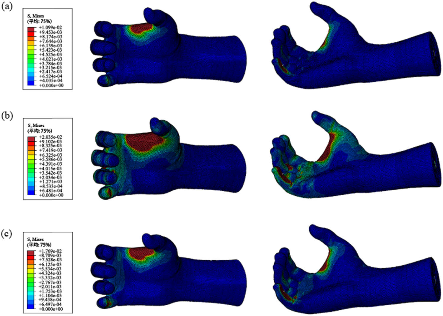 Figure 13
The stress distribution of the soft tissue of the hand: (a) the situation of wearing fabric 1 glove, (b) the situation of wearing fabric 2 glove, and (c) the situation of wearing fabric 3 glove.