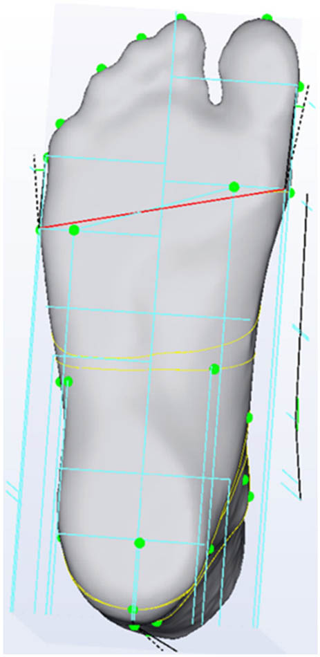 Figure 3
Forefoot width measurement.