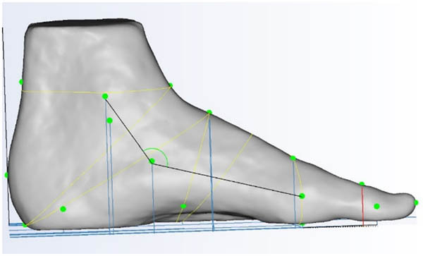 Figure 7
First toe metatarsal joint height.
