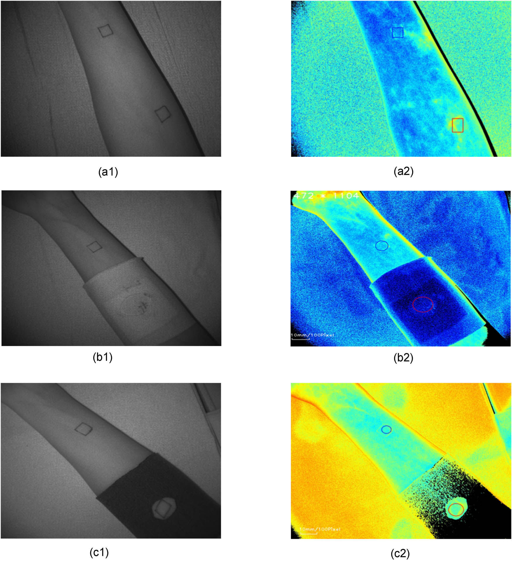 Figure 2 
                        Scanning images and microcirculation blood flow images of the subject’s arm. (a1) Scanning image without covering the sample. (a2) Microcirculation blood flow image without covering the sample. (b1) Scanning image of covering sample 1#. (b2) Microcirculation blood flow image of covering sample 1#. (c1) Scanning image of covering sample 6#. (c2) Microcirculation blood flow image of covering sample 6#.
                     