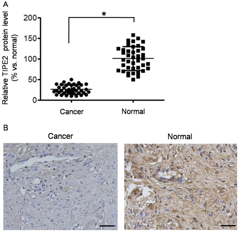 Figure 1 TIPE2 was down-regulated in cervical squamous cancer tissues. (A) Relative TIPE2 protein level (represented as % vs. normal) was detected by Western blot. The Western blot was repeated three times. *P<0.05 vs. normal. (B) Typical images of TIPE2 detection by immunohistochemistry (×200 magnification). The images showed medium differentiated squamous carcinoma and normal cervical tissue. Scale bar = 50 μm.