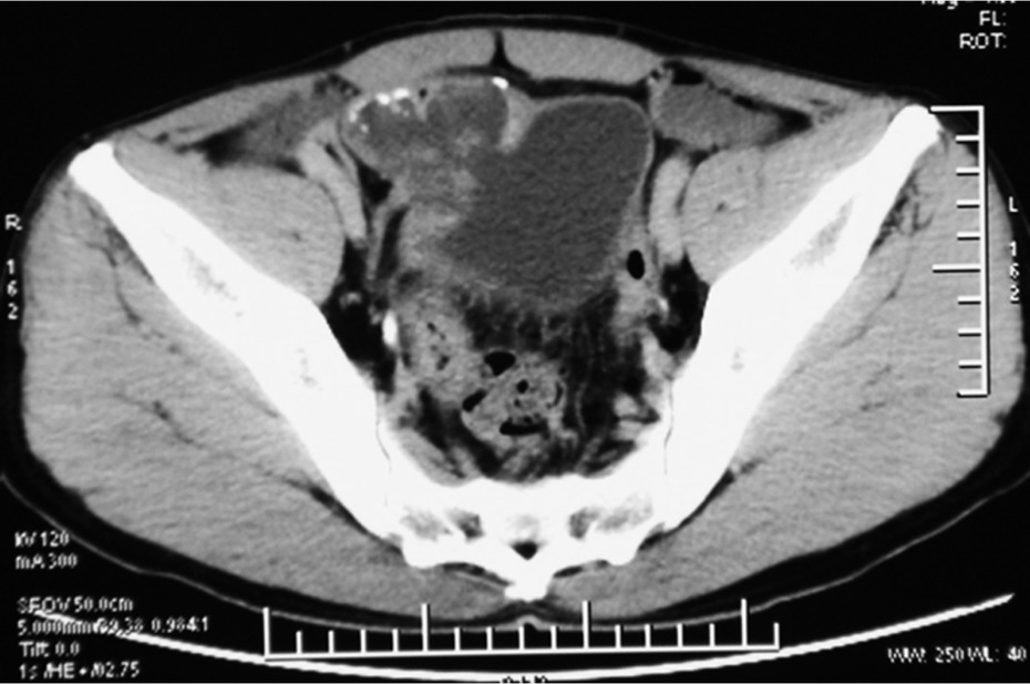Figure 1 CT scan shows an irregular slightly higher density. The largest cross-section diameter was 5.2 cm×4.8 cm and its CT value was slightly higher than the intravesical CT value. There was some punctate calcification on the edge and inside the hyperdense area.