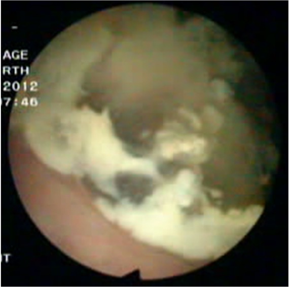 Figure 2 Cystoscopy findings. Cystoscopy was performed and an edematous broad opening with mucinous components in the right posterior wall of the bladder was observed.