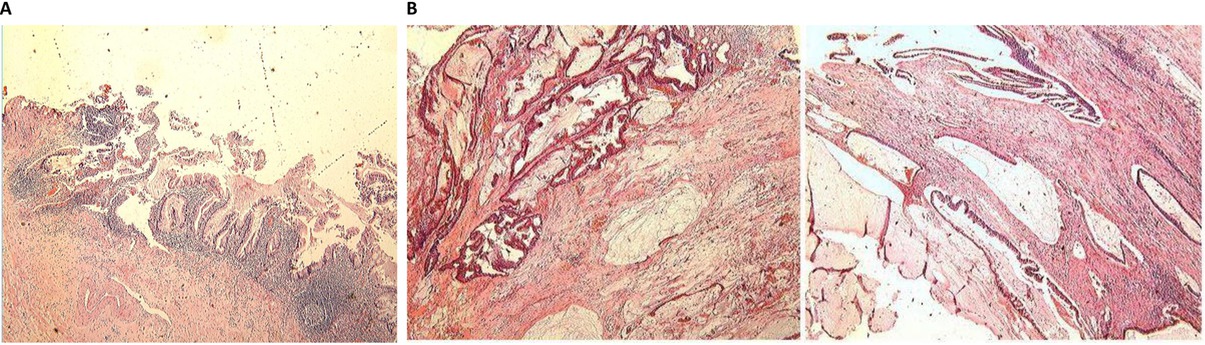 Figure 3 Pathological morphology by HE staining. Postoperative pathological examination confirmed the diagnosis of mucinous adenocarcinoma of the appendix (A). The entire bladder was filled with mucinous adenocarcinoma (B).