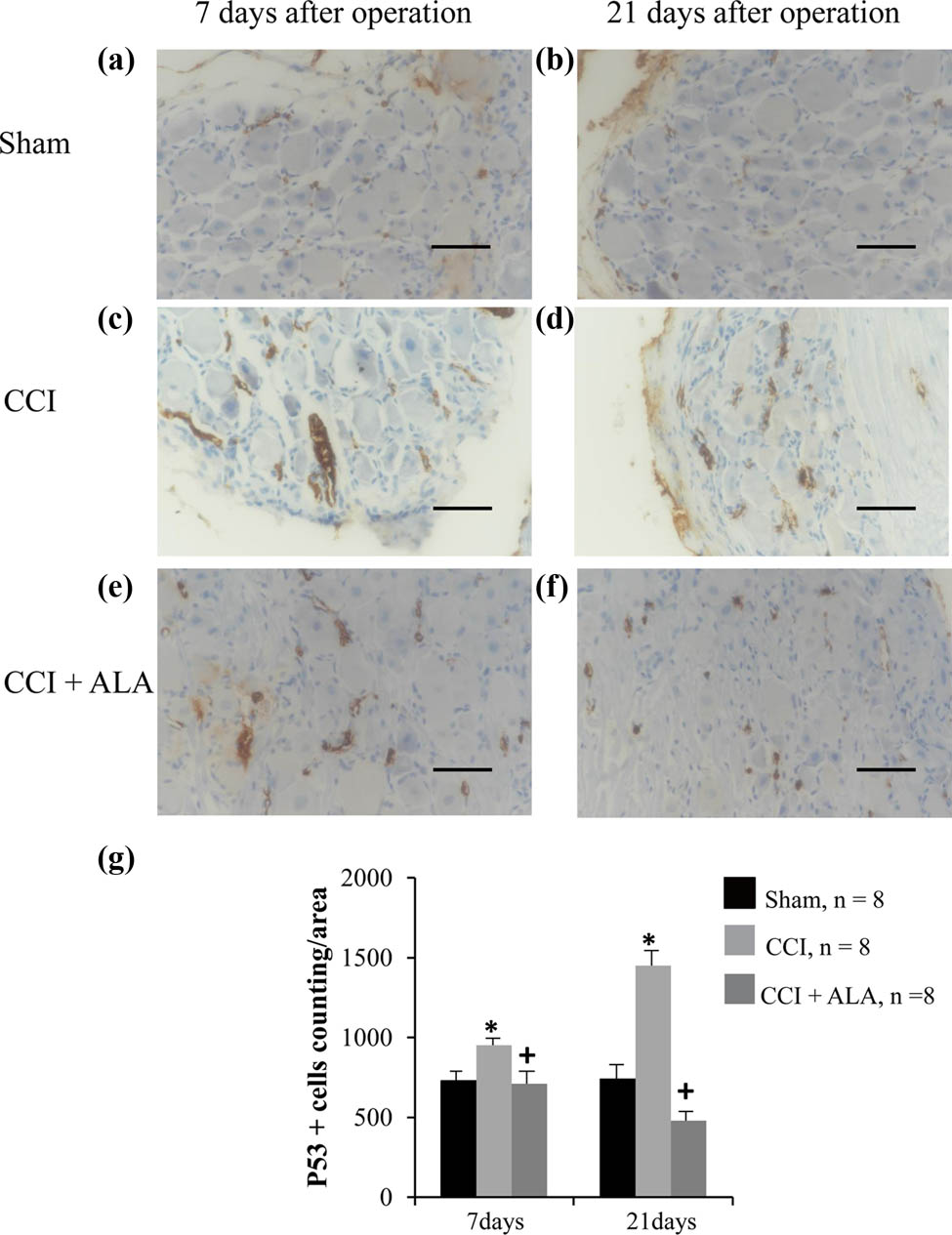 Figure 3 
               P53 immunohistochemistry of dorsal root ganglia (DRG) after chronic compression injury (CCI). Representative photo of P53 staining of DRGs in the sham group, (a) 7 and (b) 21 days after operation. The brown dots represented P53+ cells, which are rare in the sham group. Representative photos of P53 staining in CCI group, (c) 7 and (d) 21 days after operation. P53+ cells are significantly increased, even more so at 21 days than at 7 days after operation. The brown areas indicate apoptosis cells, which are small and shrunken. Representative photos of P53 staining in CCI + ALA group, (e) 7 days after operation and (f) 21 days after operation. There are fewer P53+ cells at both 7 and 21 days after operation than in the CCI group. (g) P53+ cell counts/area. CCI treatment significantly increased the number of P53+ cells, whereas ALA treatment led to normal numbers. * means P < 0.05, sham vs CCI; + means P < 0.05, CCI vs CCI + ALA; scale bar = 50 μm; magnification: 40×; one area = 20,000 pixels = 9,965 µm2.