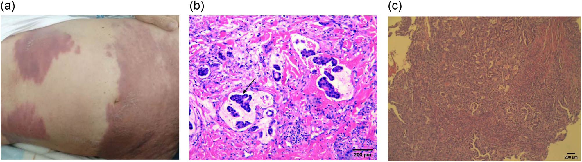 Figure 1
Representative images of the patient. (a) Skin metastases. (b) HE staining of skin lesion. The skin metastasis of adenocarcinoma and tumor thrombus (arrow) was found in vessels. Scale bar: 200 μm. (c) HE staining results of duodenum biopsy, showing primary adenocarcinoma of the descending duodenum. Scale bar: 200 μm.