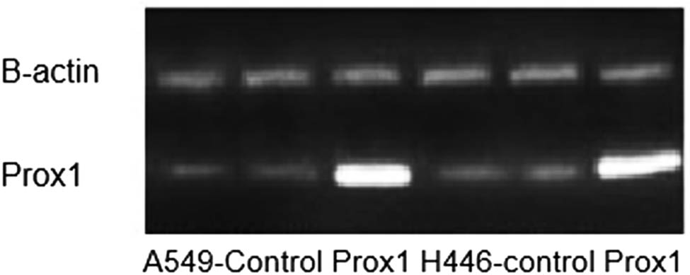 Figure 2 
                  Agarose gel experiment to verify the expression of Prox1 in lung cancer.
               