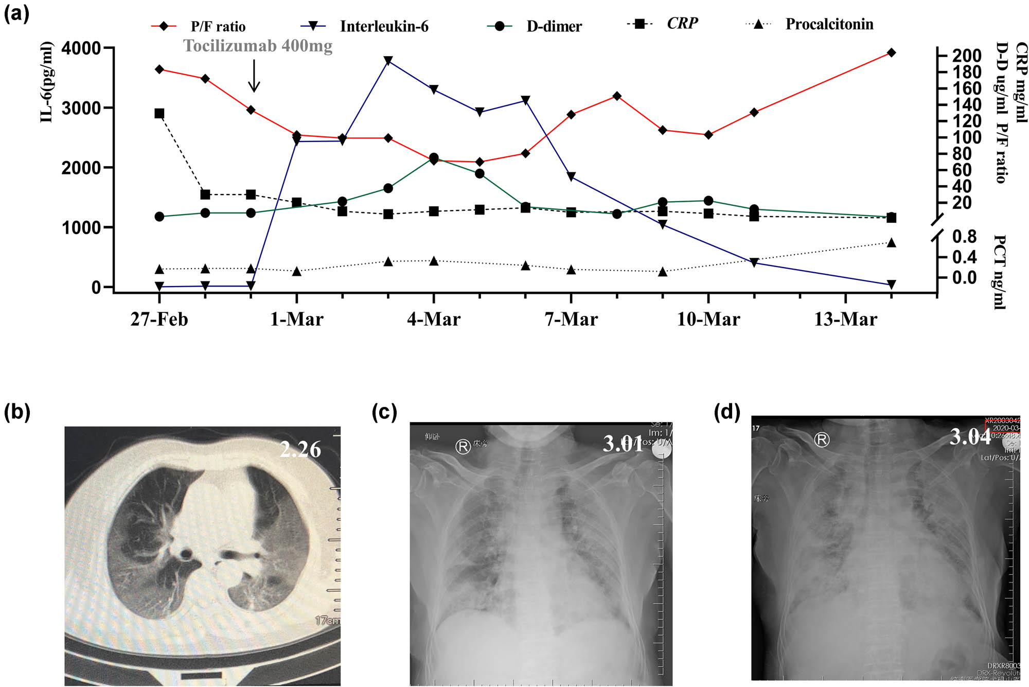 Figure 1
Changes in FiO2, P/F ratio (a), IL-6, CRP, D-dimer, PCT in a severe COVID-19 patient (a). Chest CT showed multiple shadows in both lungs on February 26 (b). X-ray showed multiple infiltrations in both lungs on March 01 (c). X-ray showed more severe infiltration 3 days before on March 04 (d). FiO2: fraction of inspiration O2; P/F ratio: SpO2/FiO2 ratio; IL-6: interleukin-6; CRP: C reactive protein; PCT: procalcitonin.