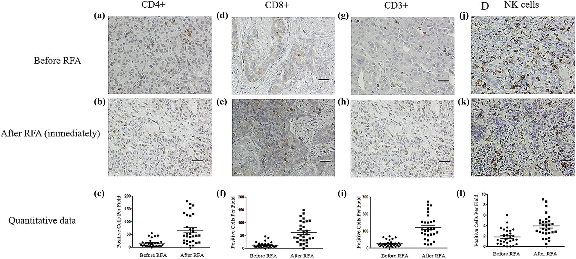 Figure 2 
                  Immunohistochemical assay of immune cells in tumor tissues before and immediately after RFA. Before RFA: (a) CD4+ cells, (d) CD8+ cells, (g) CD3+ cells, and (j) NK cells. Immediately after RFA: (b) CD4+ cells, (e) CD8+ cells, (h) CD3+ cells, and (k) NK cells. Quantitative data: (c) CD4+ cells, (f) CD8+ cells, (i) CD3+ cells, and (l) NK cells. Data are presented as mean ± SEM. The brown cells are positive cells. Bar = 100 μm. RFA: radiofrequency ablation, CD: cluster of differentiation, NK: natural killer, SEM: standard error of the mean.
               