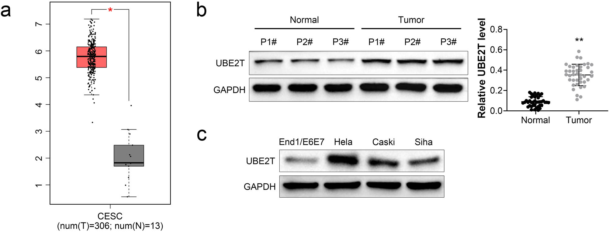 Figure 1 
                  Upregulation of UBE2T in cervical cancer. (a) UBE2T was upregulated in the cervical cancer tissues (n = 306) compared to the normal tissues (n = 13) based on GEPIA database shown. (b) Protein and mRNA expression of UBE2T were upregulated in the cervical cancer tissues compared to the normal tissues. (c) Protein expression of UBE2T was upregulated in the cervical cancer cells (HeLa, Caski, and Siha) compared to the normal cells (End1/E6E7).
               